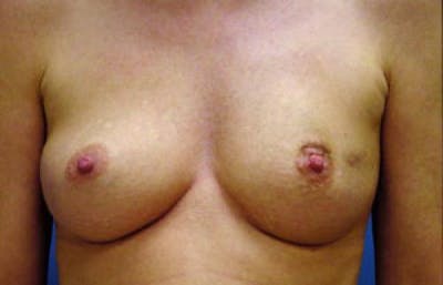 Breast Reconstruction Before & After Gallery - Patient 187460 - Image 1