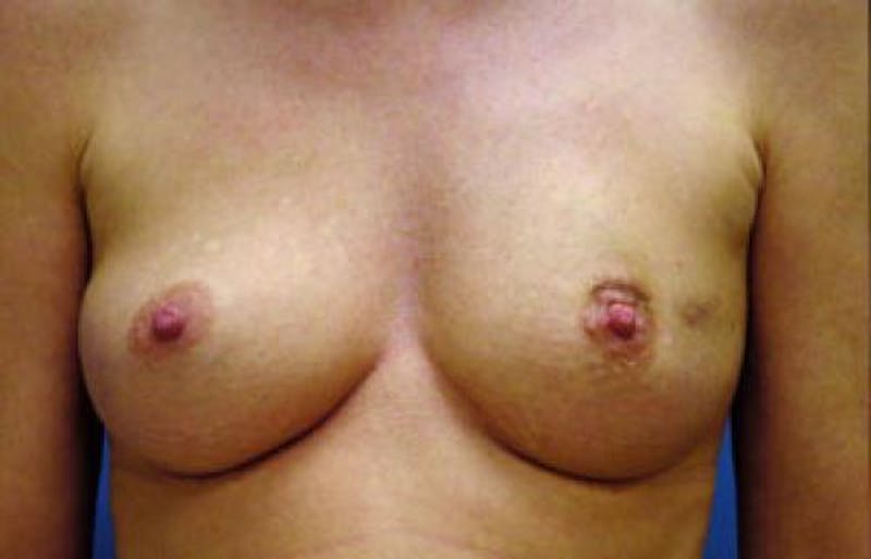 Hidden Breast Reconstruction Before & After Gallery - Patient 187460 - Image 1