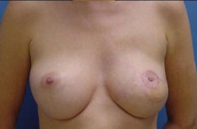 Breast Reconstruction Before & After Gallery - Patient 187460 - Image 2