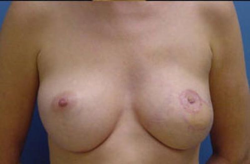 Hidden Breast Reconstruction Before & After Gallery - Patient 187460 - Image 2