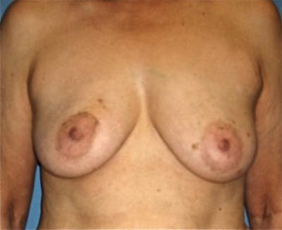 Breast Reconstruction Before & After Gallery - Patient 133883 - Image 1