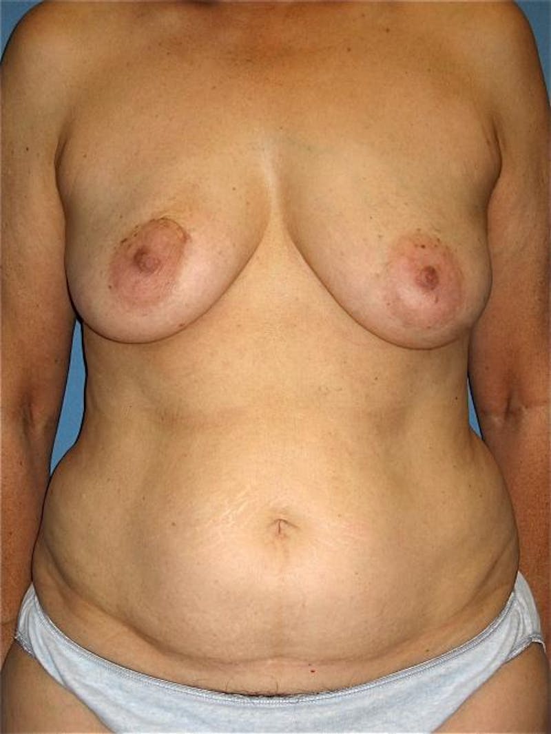 Hidden Breast Reconstruction Before & After Gallery - Patient 133883 - Image 3