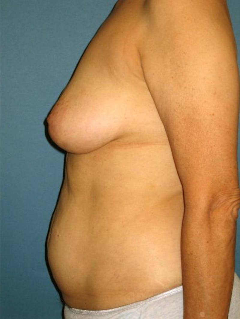 Hidden Breast Reconstruction Before & After Gallery - Patient 133883 - Image 5