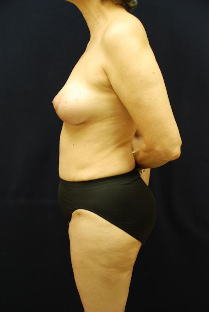 Hidden Breast Reconstruction Before & After Gallery - Patient 133883 - Image 6
