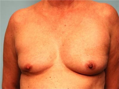 Breast Reconstruction Before & After Gallery - Patient 334115 - Image 1