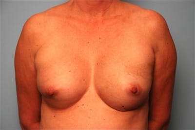 Breast Reconstruction Before & After Gallery - Patient 334115 - Image 2