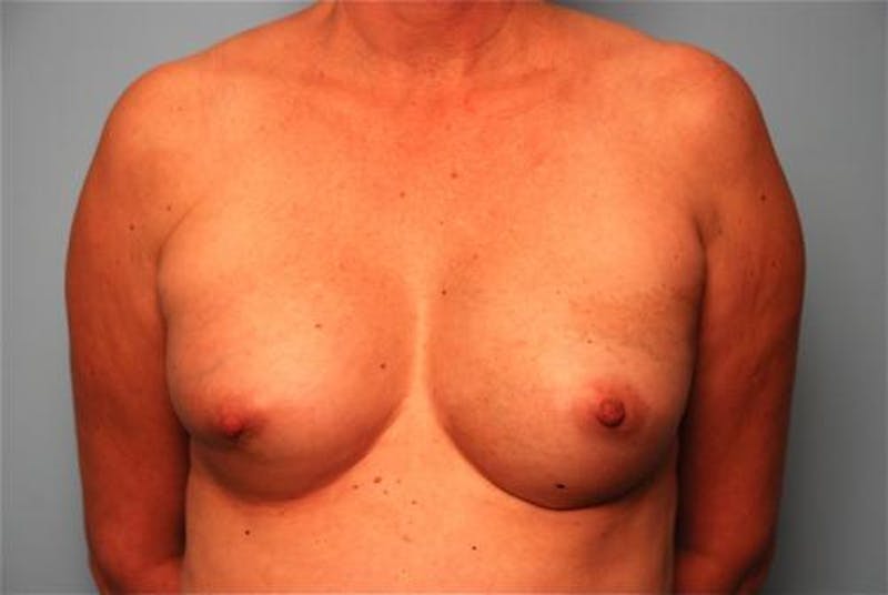 Hidden Breast Reconstruction Before & After Gallery - Patient 334115 - Image 2