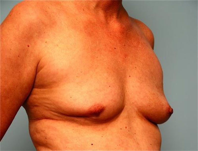 Hidden Breast Reconstruction Before & After Gallery - Patient 334115 - Image 3