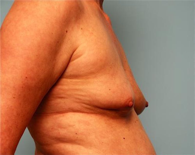 Hidden Breast Reconstruction Before & After Gallery - Patient 334115 - Image 5