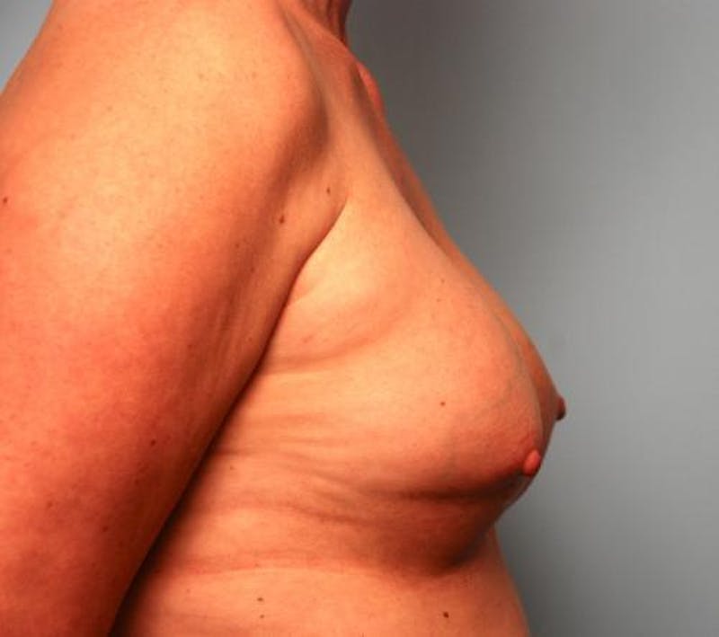 Hidden Breast Reconstruction Before & After Gallery - Patient 334115 - Image 6