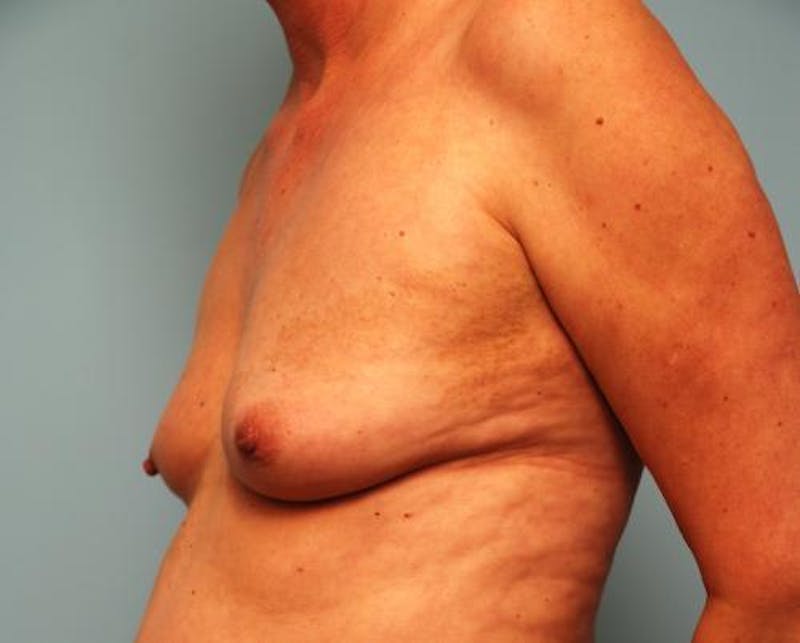 Hidden Breast Reconstruction Before & After Gallery - Patient 334115 - Image 7