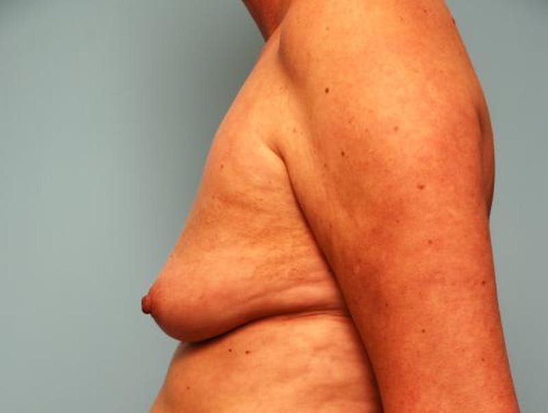 Hidden Breast Reconstruction Before & After Gallery - Patient 334115 - Image 9