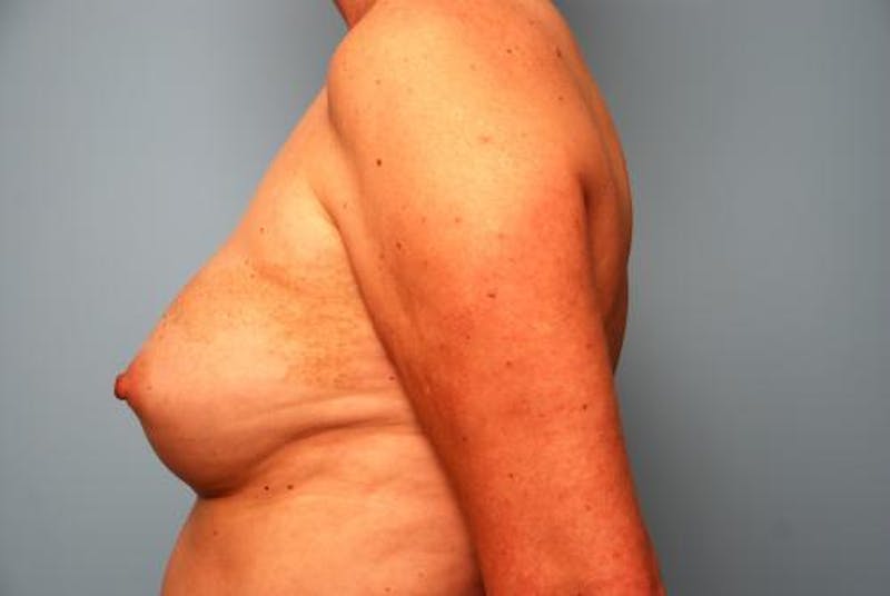 Hidden Breast Reconstruction Before & After Gallery - Patient 334115 - Image 10