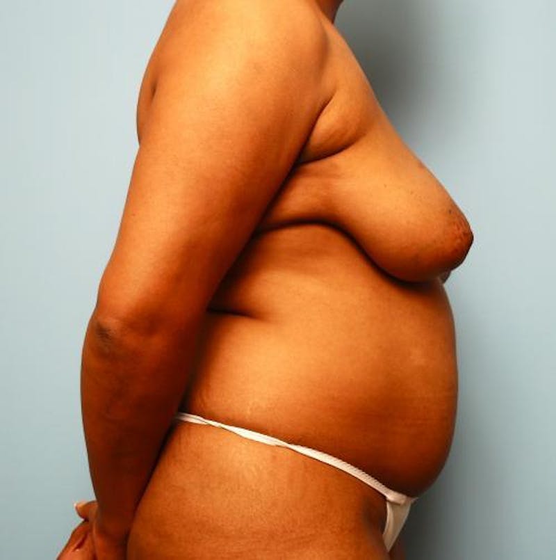 Breast Reduction Before & After Gallery - Patient 502225 - Image 5