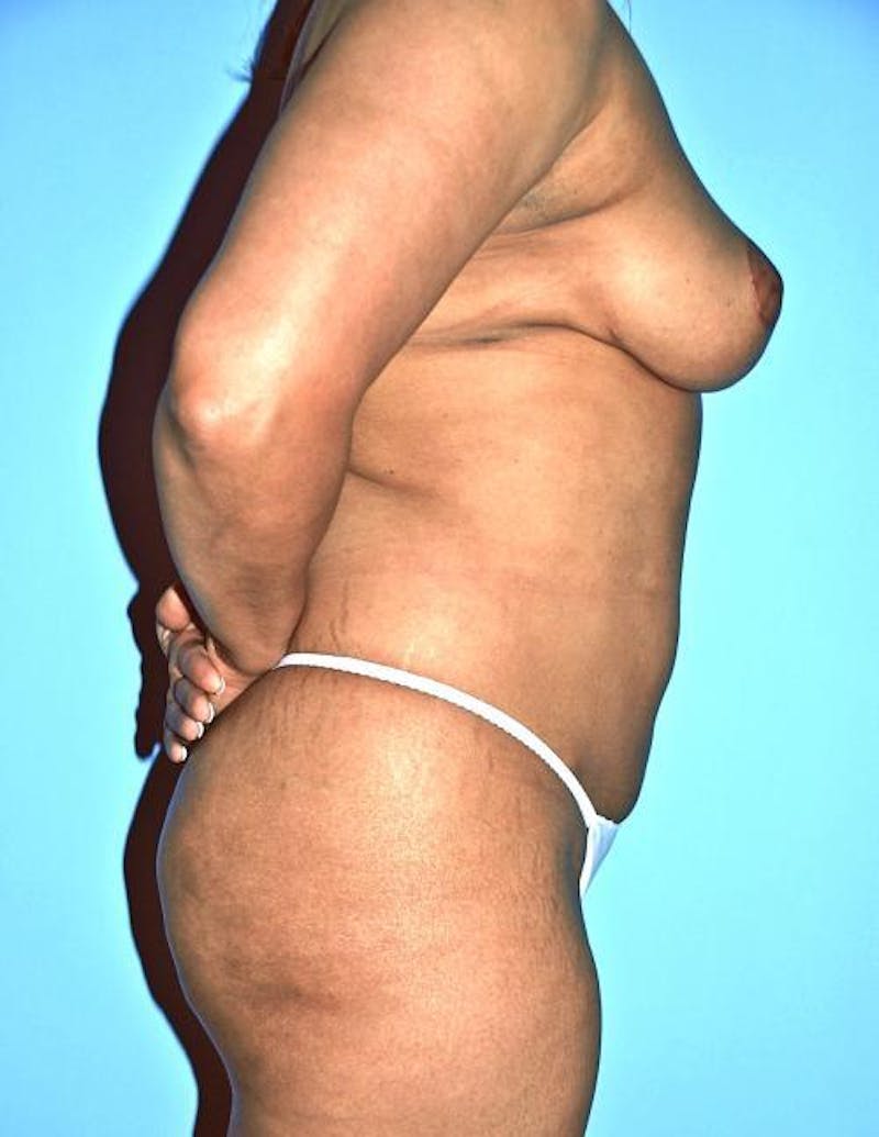 Breast Reduction Before & After Gallery - Patient 502225 - Image 6
