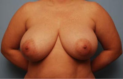 Breast Reduction Before & After Gallery - Patient 143365 - Image 1