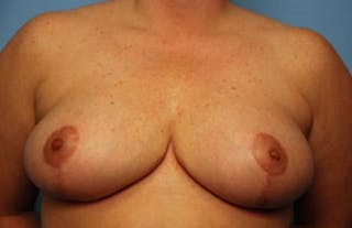 Breast Reduction Before & After Gallery - Patient 335086 - Image 2