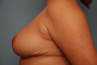 Breast Reduction Before & After Gallery - Patient 335086 - Image 10