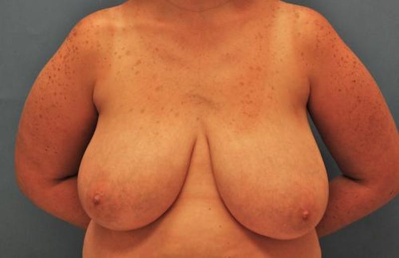 Breast Reduction Before & After Gallery - Patient 875548 - Image 1
