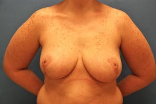 Breast Reduction Before & After Gallery - Patient 101253 - Image 2