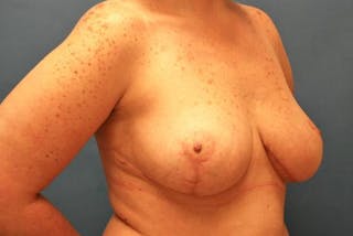 Breast Reduction Before & After Gallery - Patient 101253 - Image 4