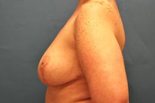 Breast Reduction Before & After Gallery - Patient 101253 - Image 10