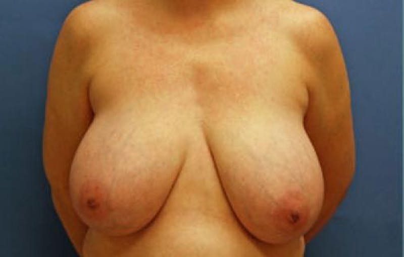 Breast Reduction Before & After Gallery - Patient 429410 - Image 1