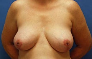 Breast Reduction Before & After Gallery - Patient 133687 - Image 2