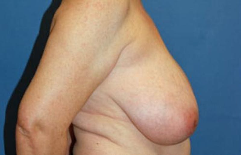 Breast Reduction Before & After Gallery - Patient 429410 - Image 5