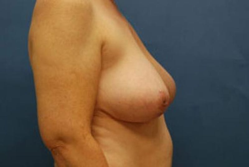Breast Reduction Before & After Gallery - Patient 429410 - Image 6