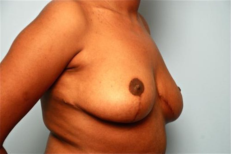 Breast Reduction Before & After Gallery - Patient 376559 - Image 4
