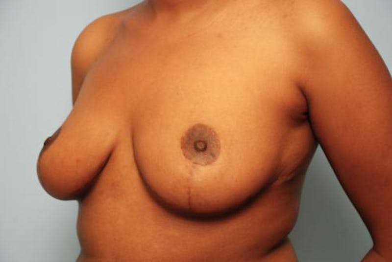 Breast Reduction Before & After Gallery - Patient 376559 - Image 8