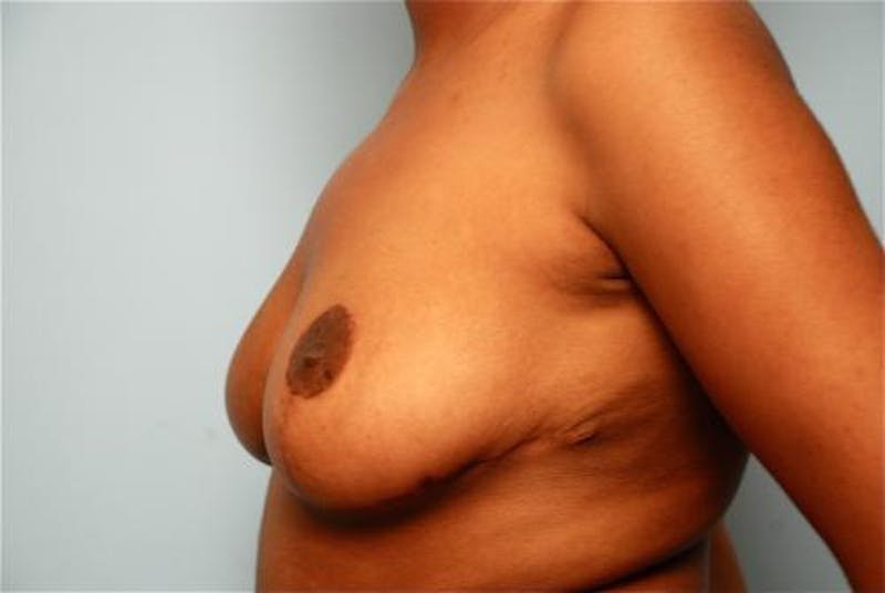 Breast Reduction Before & After Gallery - Patient 376559 - Image 10