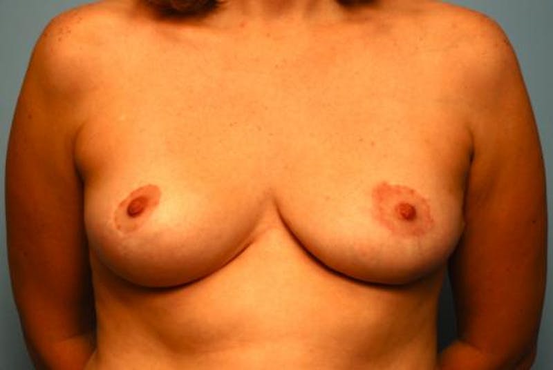 Breast Reduction Before & After Gallery - Patient 481216 - Image 2