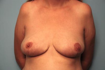 Breast Reduction Before & After Gallery - Patient 166058 - Image 2