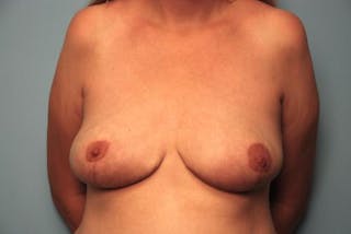 Breast Reduction Before & After Gallery - Patient 318162 - Image 2