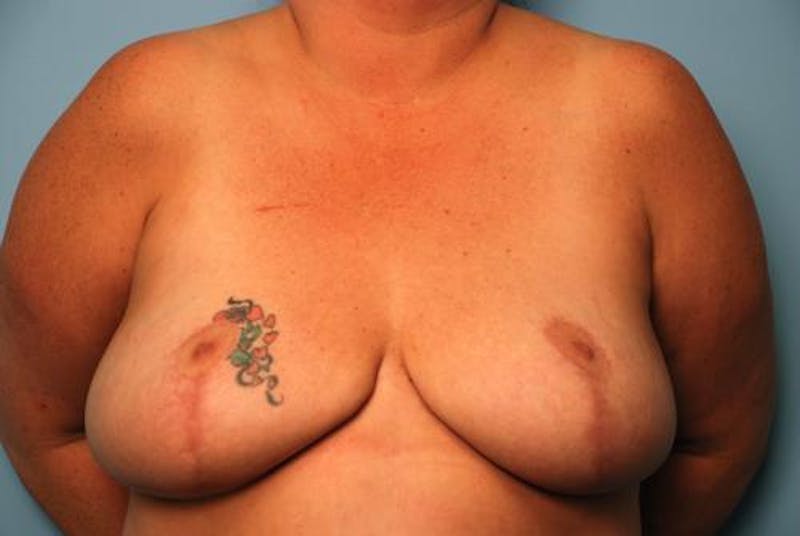 Breast Reduction Before & After Gallery - Patient 668759 - Image 2
