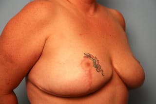 Breast Reduction Before & After Gallery - Patient 236689 - Image 4