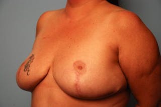 Breast Reduction Before & After Gallery - Patient 236689 - Image 8