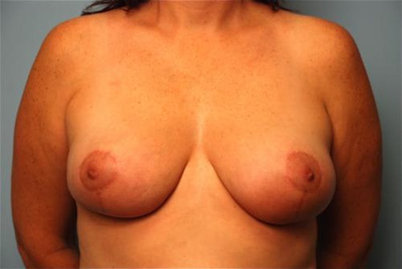 Breast Reduction Before & After Gallery - Patient 143629 - Image 2
