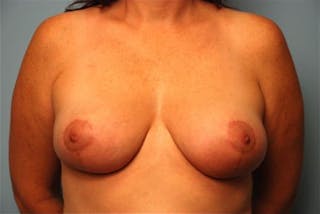 Breast Reduction Before & After Gallery - Patient 366753 - Image 2