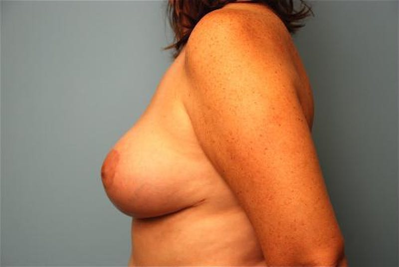 Breast Reduction Before & After Gallery - Patient 143629 - Image 10