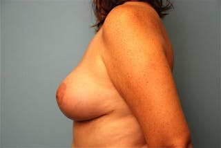 Breast Reduction Before & After Gallery - Patient 366753 - Image 10