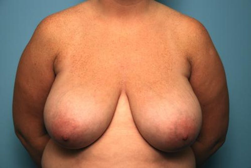 Breast Reduction Before & After Gallery - Patient 394462 - Image 1