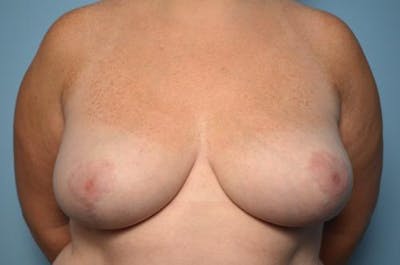 Breast Reduction Before & After Gallery - Patient 394462 - Image 2