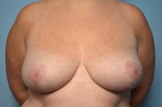 Breast Reduction Before & After Gallery - Patient 355799 - Image 2
