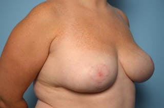 Breast Reduction Before & After Gallery - Patient 355799 - Image 4