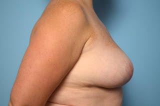 Breast Reduction Before & After Gallery - Patient 355799 - Image 6