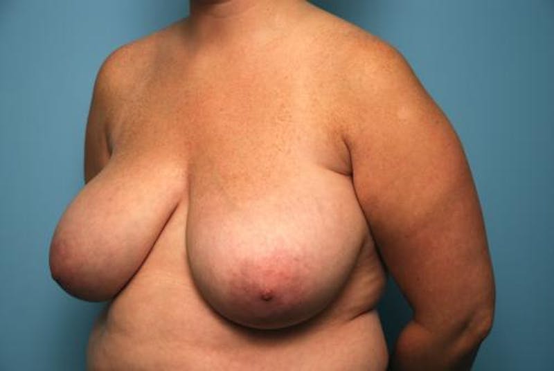 Breast Reduction Before & After Gallery - Patient 394462 - Image 7