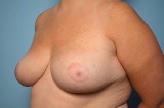 Breast Reduction Before & After Gallery - Patient 355799 - Image 8